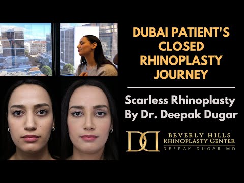 Video thumbnail: Dubai Nose Job | Scarless Nose Rhinoplasty | Dr. Deepak Dugar, Beverly Hills 90210