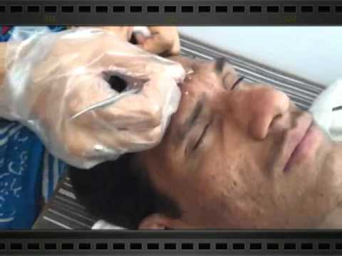 Acne vulgaris (Pimples)treatment by Dr Bhutada