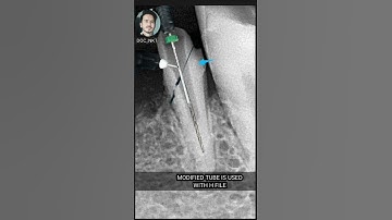 Separated Instrument Retrieval || Modified Tube Technique.             #shorts #shortvideo #dentist