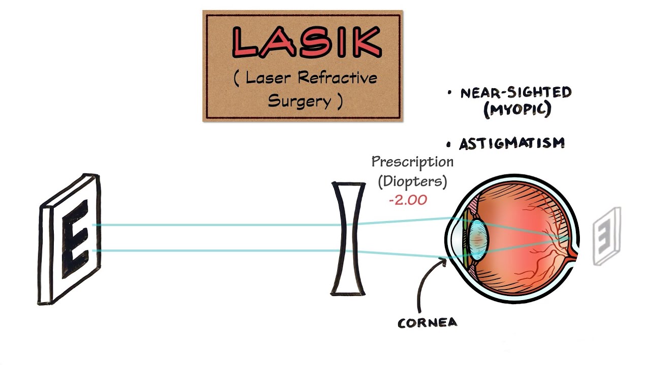 LASIK with Dr. Colby Stewart