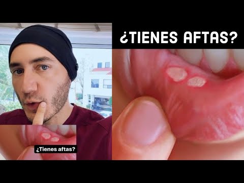 Video: ¿Qué deficiencias provocan úlceras bucales?