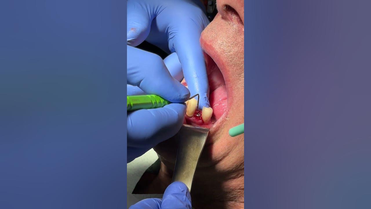 what-does-bone-grafting-look-like-youtube