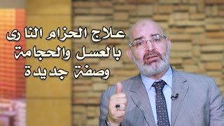 علاج الحزام النارى وصفات من الطبيعة دكتور أمير صالح