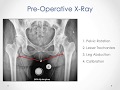 Templating For A Total Hip Replacement