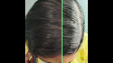 Amazing Scalp Micropigmentation Results in Kerala