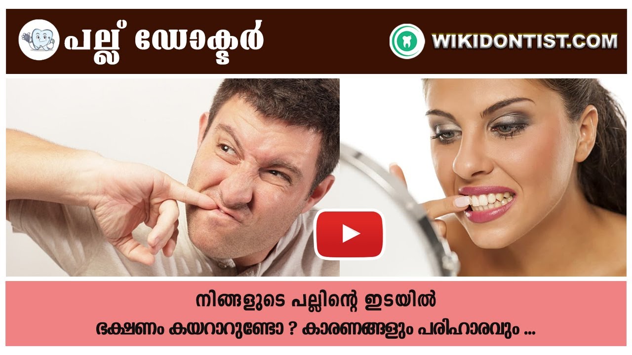 നിങ്ങളുടെ പല്ലിന്റെ ഇടയിൽ ഭക്ഷണം കയറാറുണ്ടോ ? കാരണങ്ങളും പരിഹാരവും...food getting in between teeth ?
