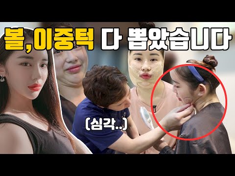 (몰아보기) 이중턱 지방흡입 I 이중턱, 볼살, 턱살 얼굴지방흡입으로 제거했어요 변화과정, 가격, 통증, 드레싱, 후관리,붓기 리얼토크까지! [쀼]