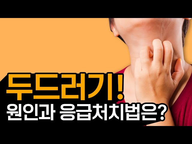 두드러기 위급할 때 응급처치/두드러기대처법/두드러기가라앉히는법 - Youtube