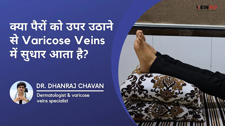 Relief for Varicose Veins: Elevating Legs for Better Circulation