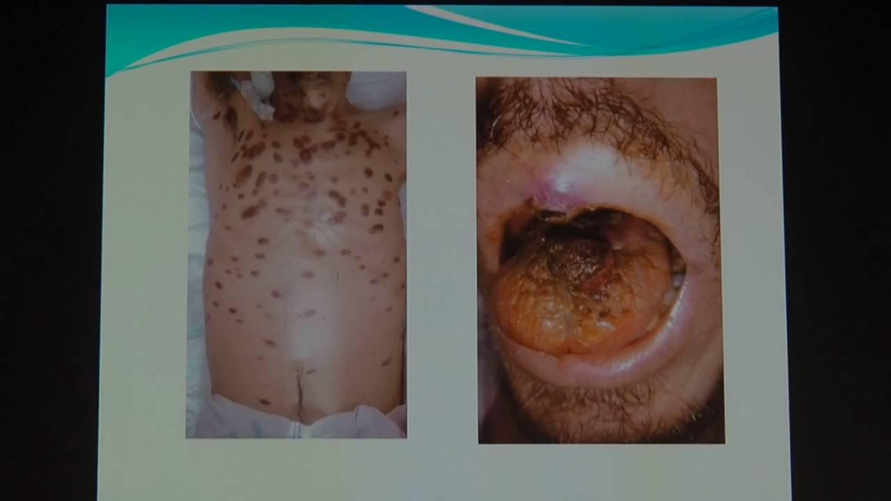 12 Кровикова ЖВ – Саркома Капоши Клиническое наблюдение