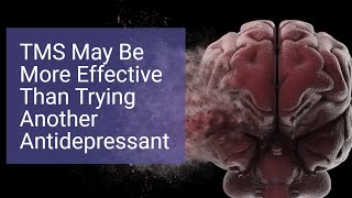 Tried Multiple Antidepressants? Consider Switching to TMS - STAR*D vs. Carpenter Study Results