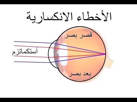 فيديو: هل الأخطاء الانكسارية وراثية؟