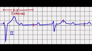 Cardiac Pacing (Failure to Capture/Failure to Sense)