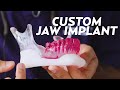 A custom jaw implant surgery for matthew  plastic with dr dhir