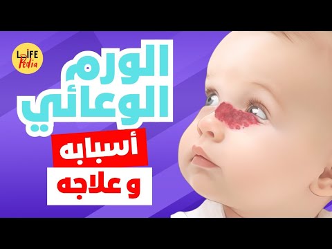 الورم الوعائي أنواعه أسبابه و طرق علاجه