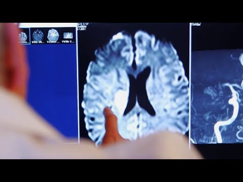 Santé - AVC