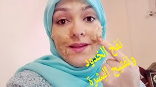 نفخ الخدود/زيادة الوزن/كوماج بالشكلاط للجسم bio شريتو مؤخرا