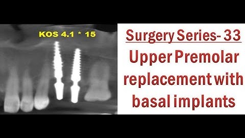 Upper premolar replacement with basal implants  Immediate loading