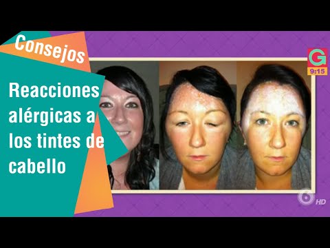 Vídeo: Alergia A Los Tintes Capilares: Síntomas, Tratamiento Y Alternativas De Color