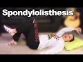 Spondylolisthesis exercises  stretches for back pain  ask doctor jo