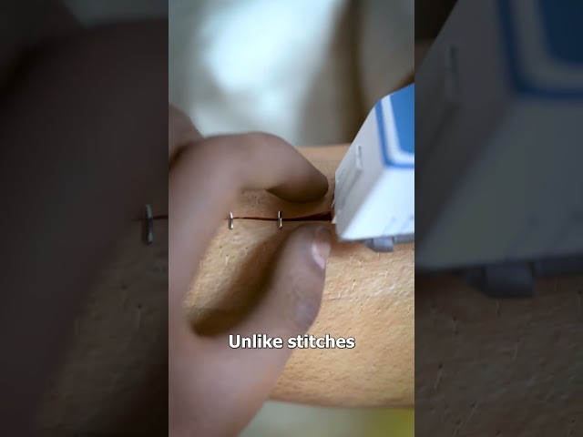 How Medical Staples Work 🤔 class=
