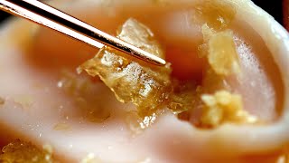 [True record] The largest earwax removal ever | ASMR