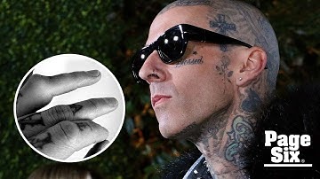 Travis Barker shares gnarly photo of dislocated finger before Blink-182 tour | Page Six
