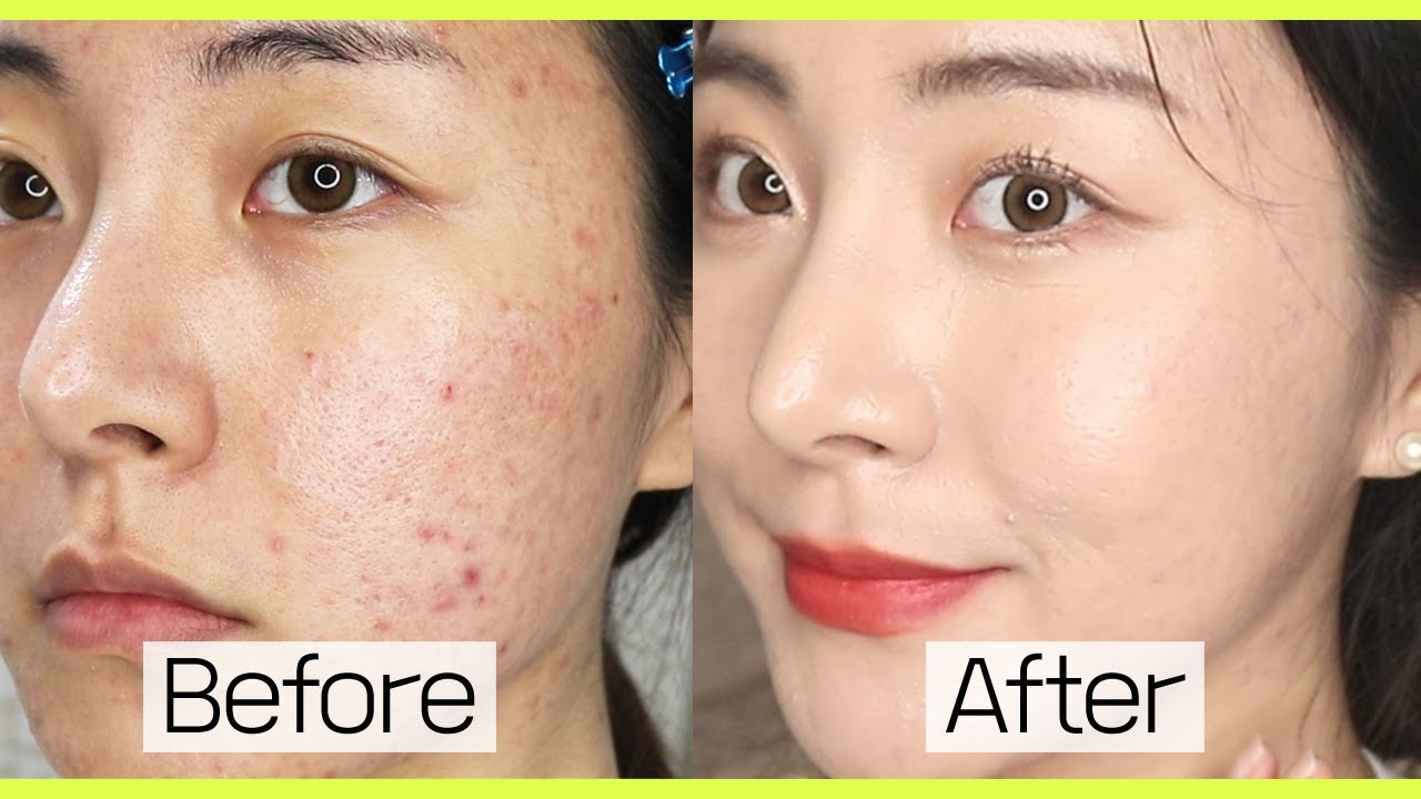 Tips On Covering Pores + Acne Scars Spotlessly!! - Youtube