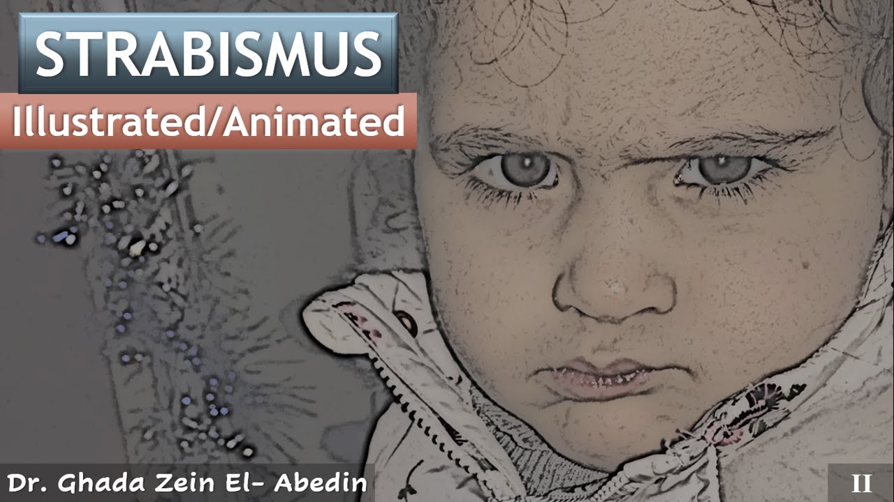 2# Strabismus "Illustrated/Animated"| Angle kappa