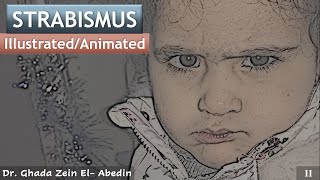 2# Strabismus Illustrated/Animated| Angle kappa
