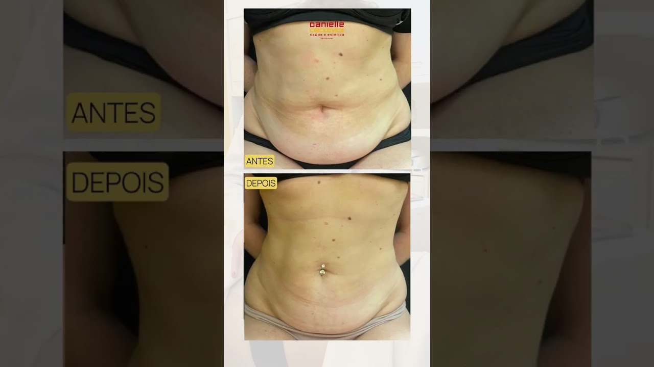 Criolipólise de Placas