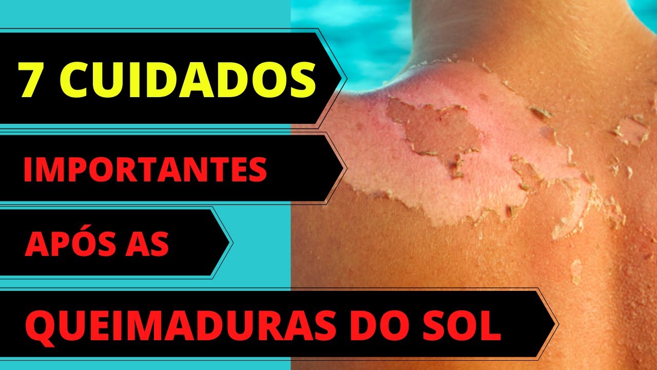 7 CUIDADOS IMPORTANTES APÓS TER QUEIMADURAS DO SOL - YouTube