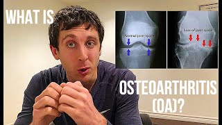 Osteoarthritis Oa Explained Aleks Physio