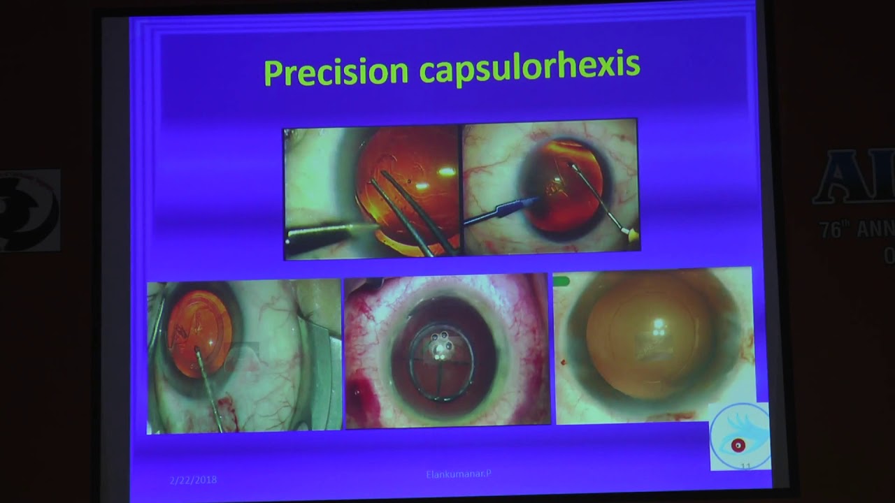 AIOC2018 - GP075 - Topic - Rhexis hold sheet anchor for cataract ...