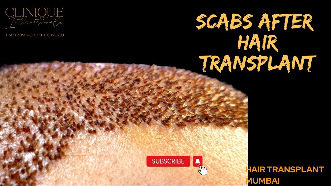 Glamdoc  A Chain Of Hair Transplant Clinics in VashiMumbai  Best Hair  Transplant Clinics in Mumbai  Justdial