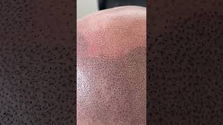 Hair tattoo details #scalpmicropigmentation #hairtattoo