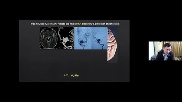Bypass for Complex MCA Aneurysm
