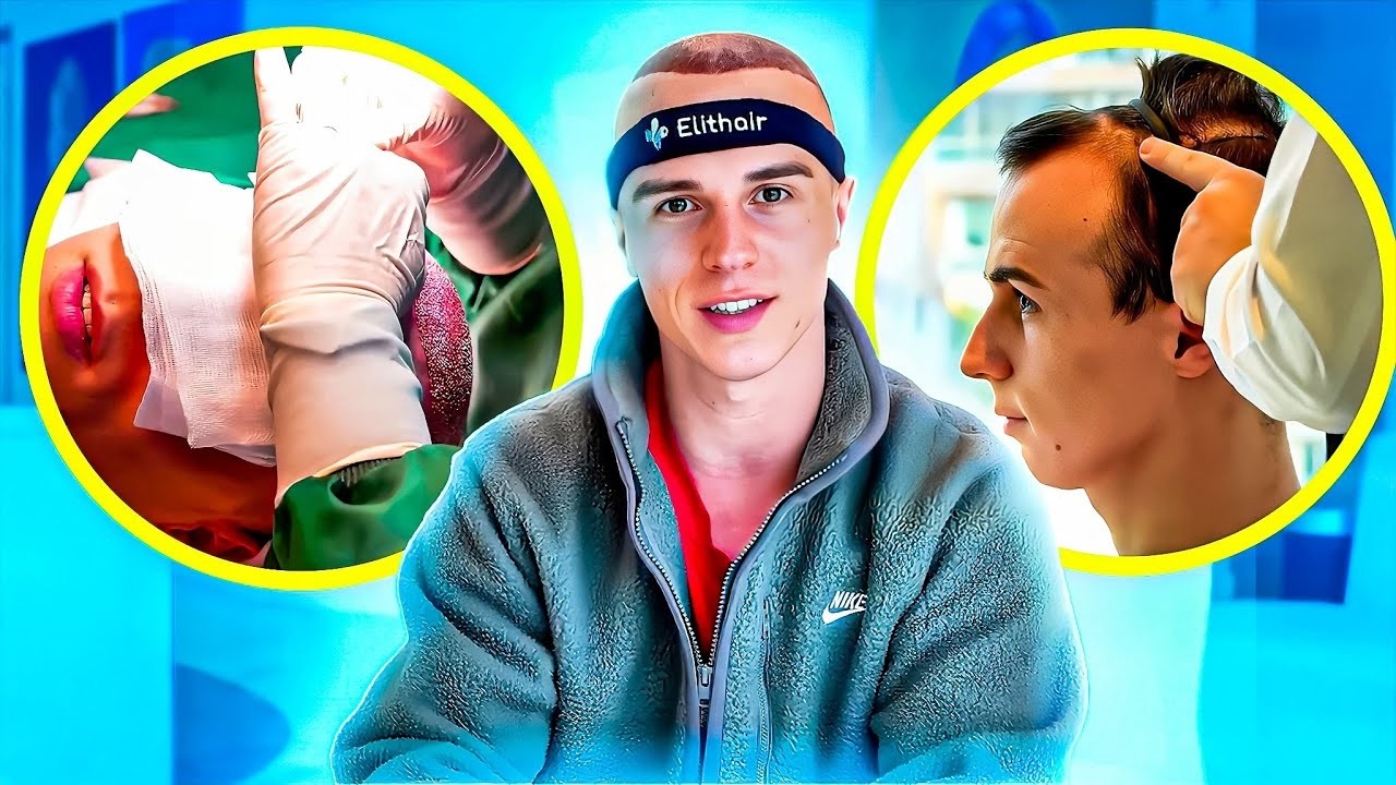 Greffe de Cheveux en Turquie : la Vérité (tout ce qu'on ne te dit pas)