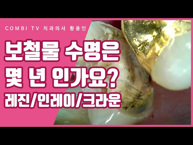 치과 보철물 레진, 인레이, 크라운의 수명은 얼마나 갈까?