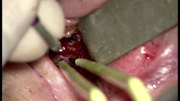 TONES Surgery – Cauterization (Graphic)