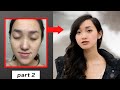 i hated myself (PART 2) -  How I got rid of acne & grow LONG BEAUTIFUL hair