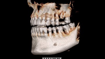 Immediate Implantation at Fresh Extraction Sockets by Dr.Anwar Al-Abdullah