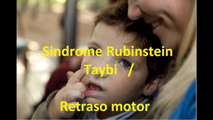 SÍNDROME DE RUBINSTEIN-TAYBI - CANAL INFANTIL