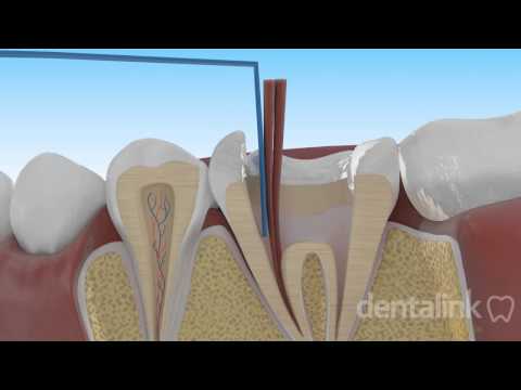 Vídeo: Pots retirar un conducte radicular?