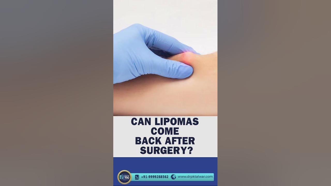 does-lipoma-come-back-after-surgery-lipoma-repeated