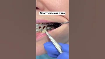 Эластичные тяги на брекеты