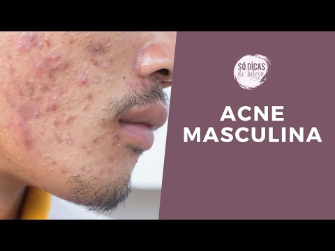 Vídeo: Os 8 Melhores Tratamentos Para Acne Masculinos Para Pele Super Limpa Na Primavera De 2021