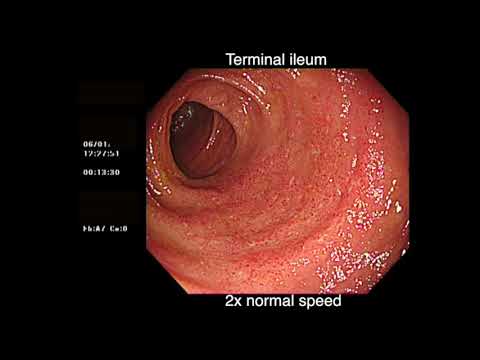 Video: Var är backwash ileitis?