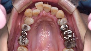 38-year-old woman with a large number of silver fillings] Revival