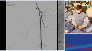 Live Case Presentation #5  Aortoiliac Bifurcation CTO Intervention Metzger Session V  Artoiliac Dis